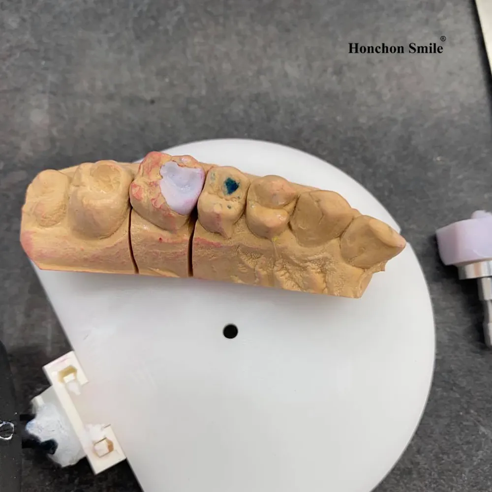 The Role of Lithium Disilicate in Modern Restorative Dentistry(图4)