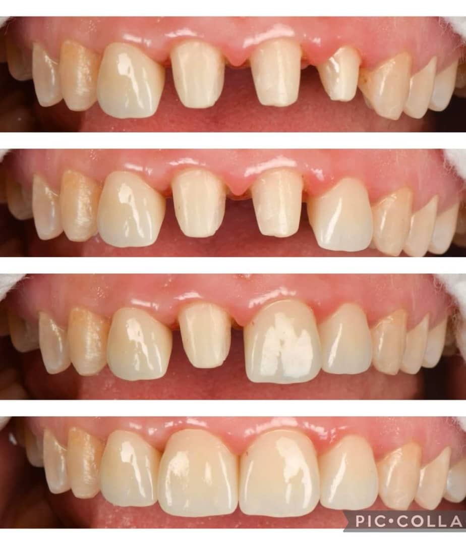 Mastering Pre-shaded Zirconia Blocks: From Material Selection to Aesthetic Excellence(图3)