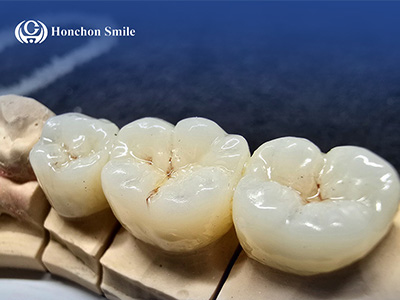 Mastering Zirconia Blocks in Dentistry
