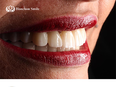 Zirconia Discs: The Smart Choice for Dental Labs and Material Distributors