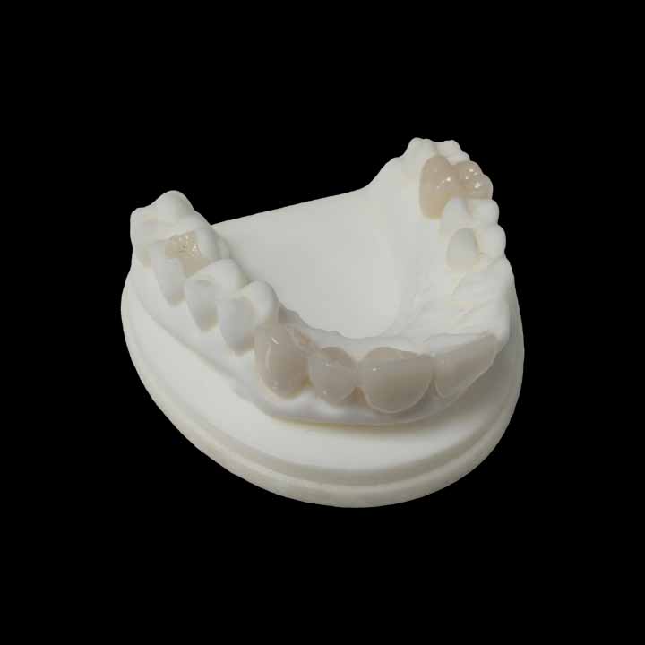 Dental Inlays vs Fillings: When and Why to Choose an Inlay(图1)