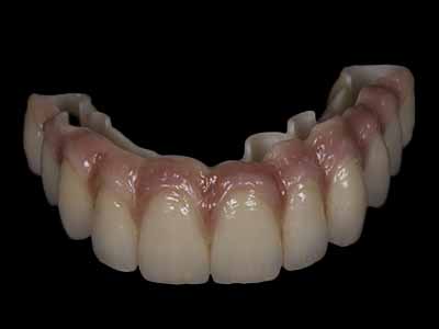 Advantages of Digital Complete Denture Materials – High-Precision Solutions for Dental Labs