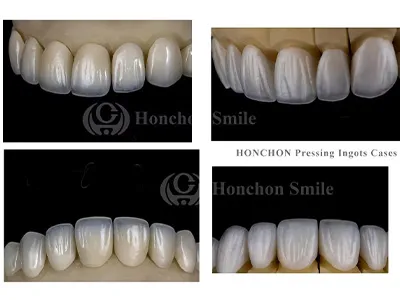 Dental Lithium Disilicate Glass Ceramics — Properties, Manufacturing Process, and Clinical Applicati