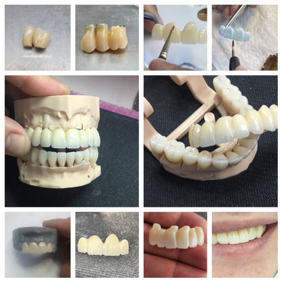 Why do dentists recommend choosing zirconia all-ceramic teeth?