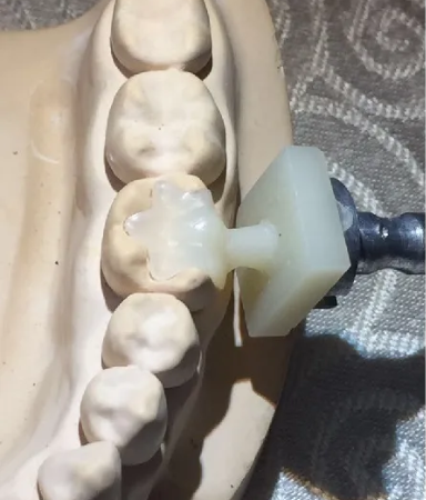 Dental PMMA Blocks: Being Developed and Used(图3)