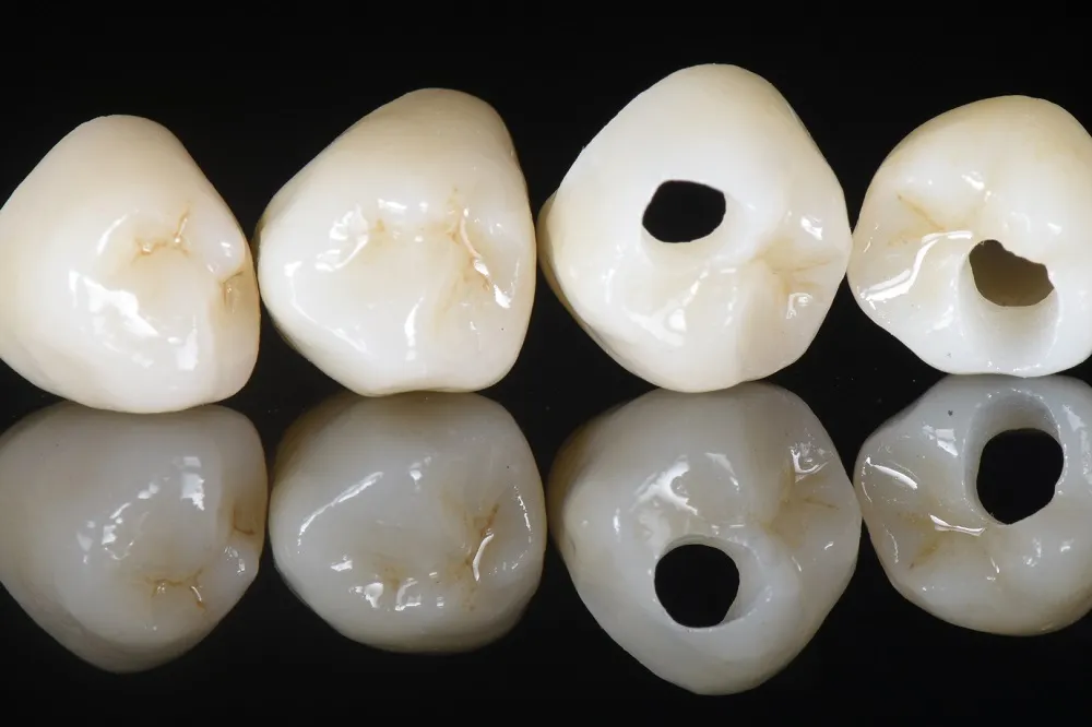 All-ceramic Crown and Restorations: Common Types(图1)