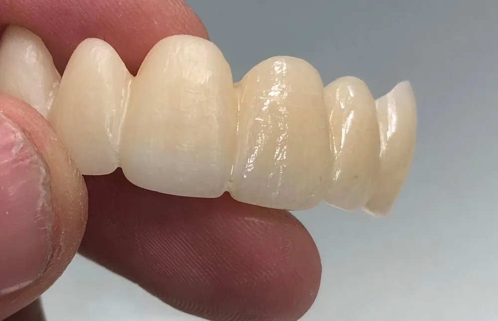 All-ceramic Crown and Restorations: Common Types(图3)