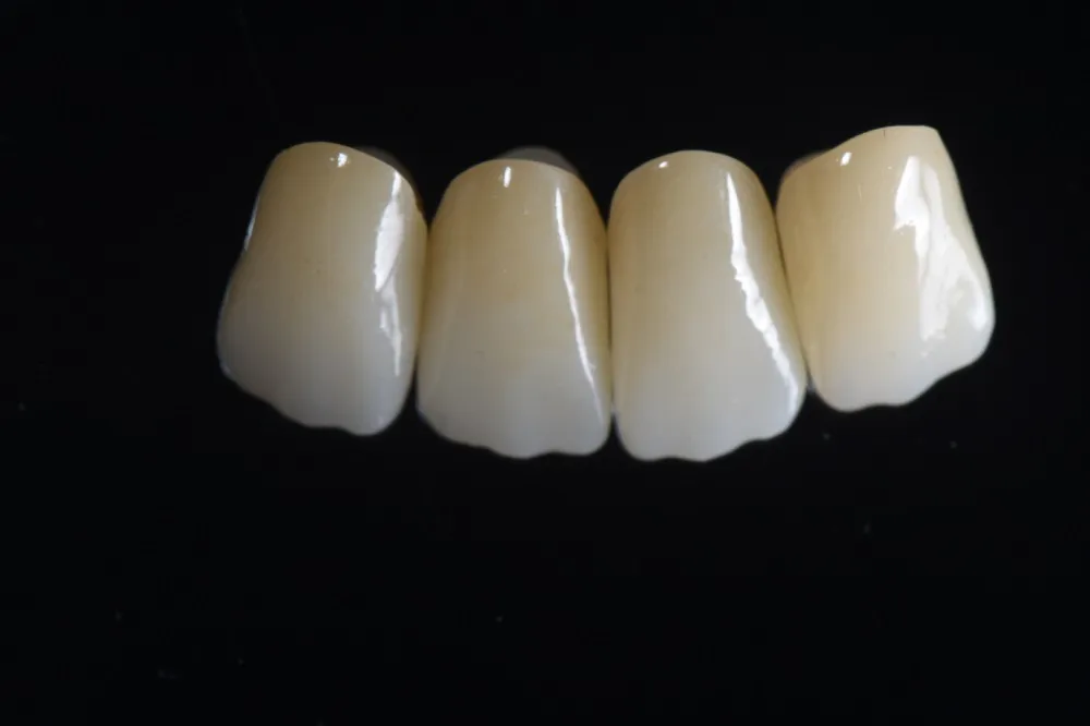 Pick Your New Crown: Zirconia and Gold(图2)