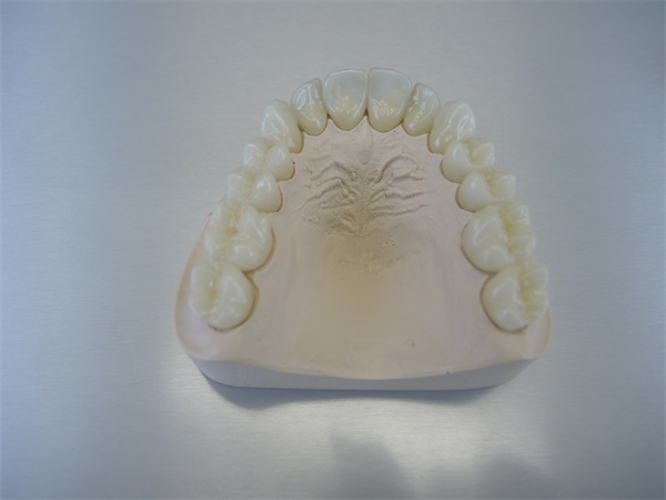Comparison of Dental Bridges and Dental Implants(图1)