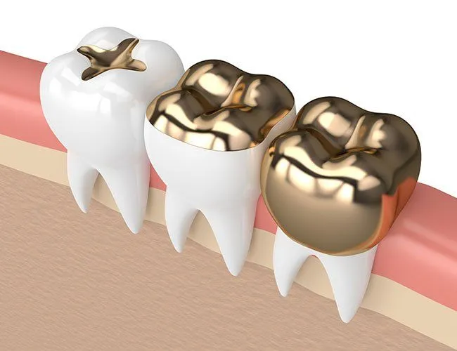 The Best Material for Dental Crowns