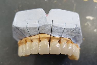 Differences Between PFM and Zirconia Crowns