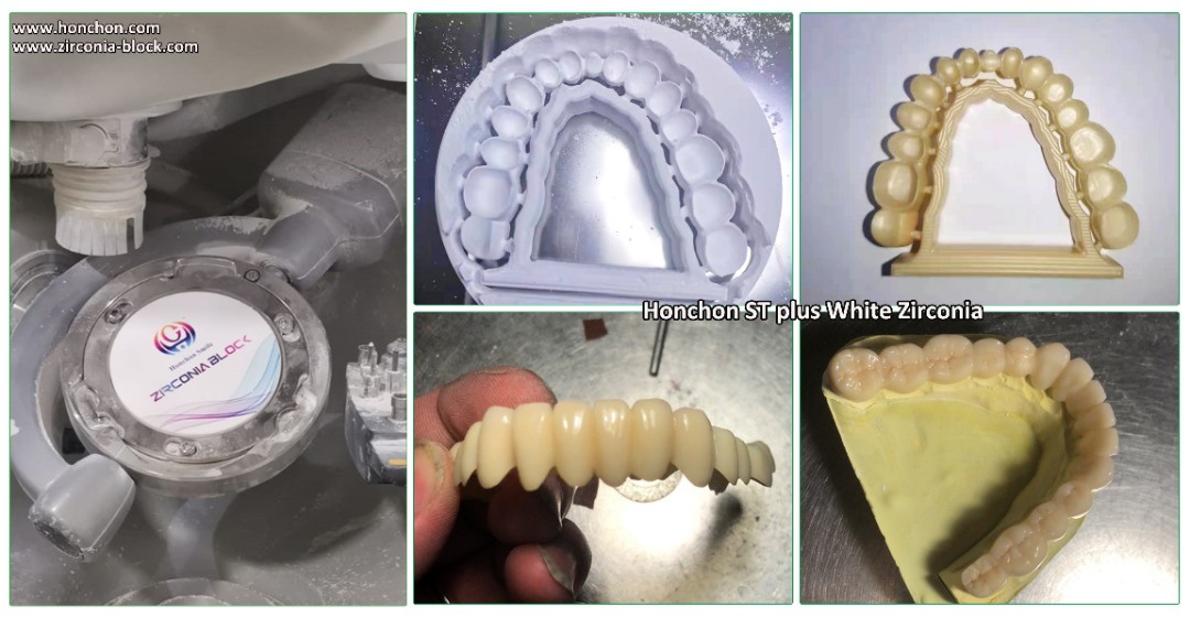 Do zirconia crowns fall off easily?(图2)