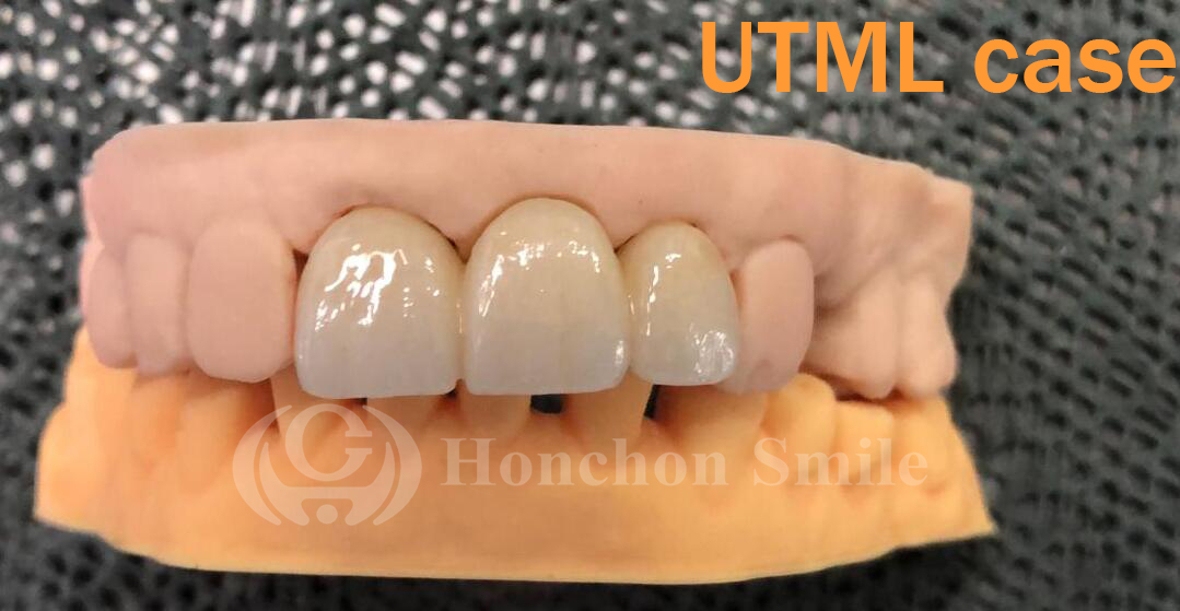 Do zirconia crowns fall off easily?(图1)