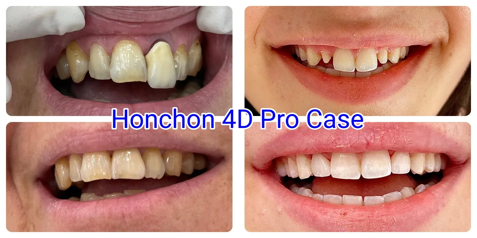 HONCHON 4D Pro Multilayer Zirconia Blocks(图7)