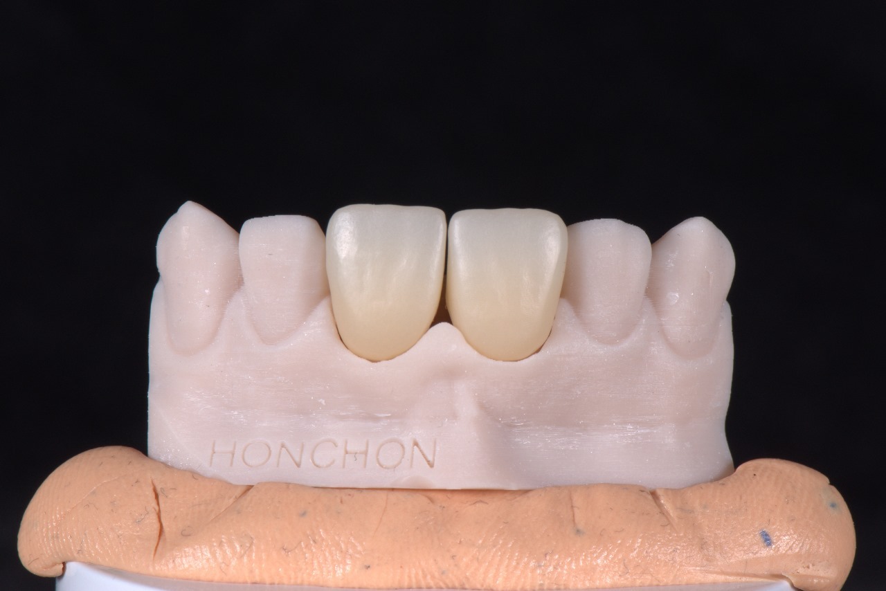 Multi-layer gradient zirconia ceramic blocks that combine function and aesthetics(图1)