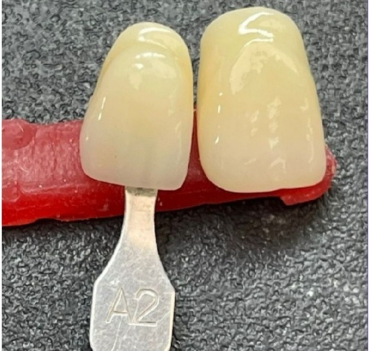 Multi-layer gradient zirconia ceramic blocks that combine function and aesthetics(图2)