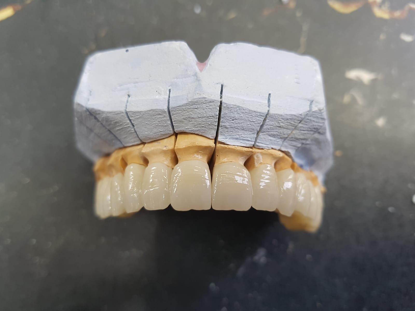 What Can Dentists Do to Change A Crown If It Doesnt Fit(图2)