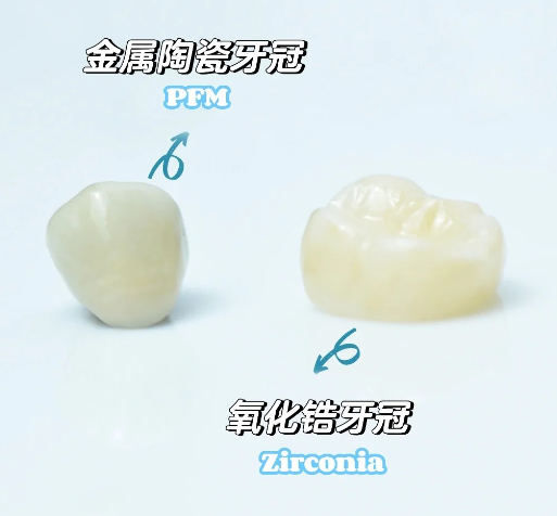 Differences Between PFM and Zirconia Crowns(图1)